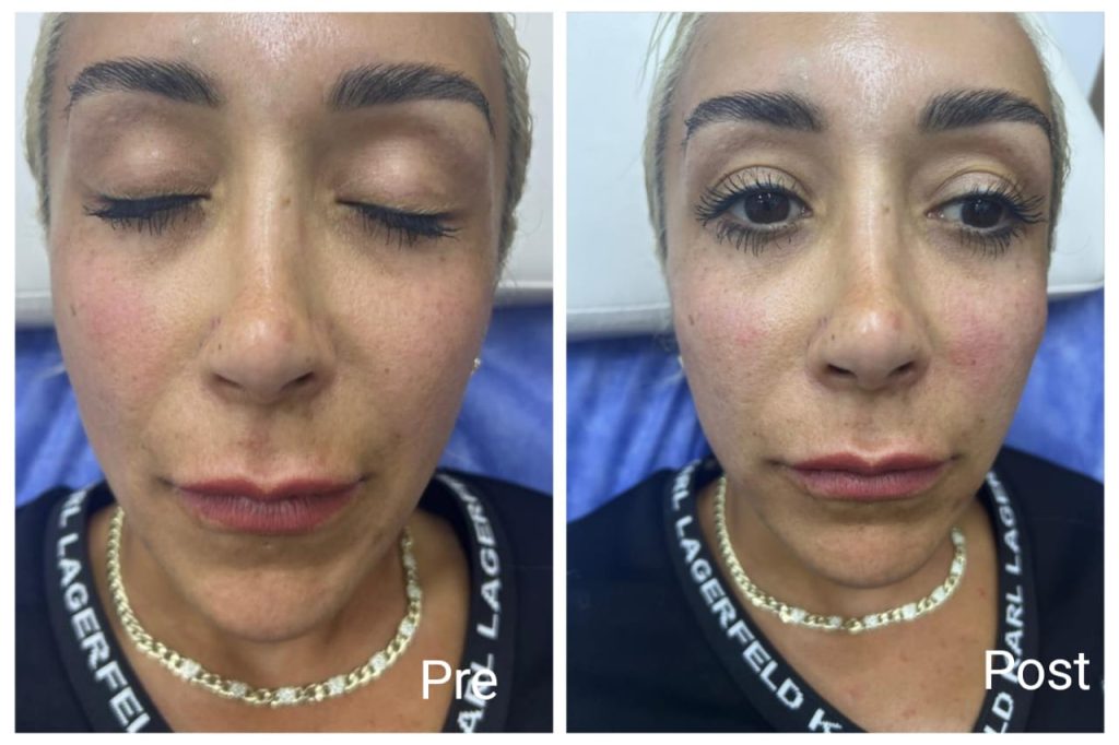 Profhilo injection in Hurghada